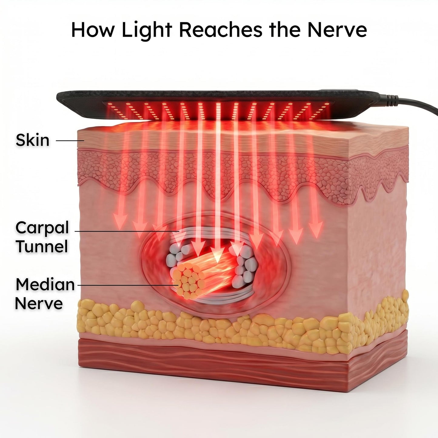The Treatwave Neural Relief Protocol